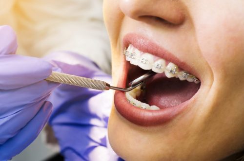 Dental Braces Sterling Heights MI