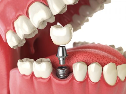 Dental Implants Oak Park